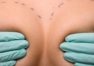 Оперативна пластична хирургия – подготовка за уголемяване на бюста